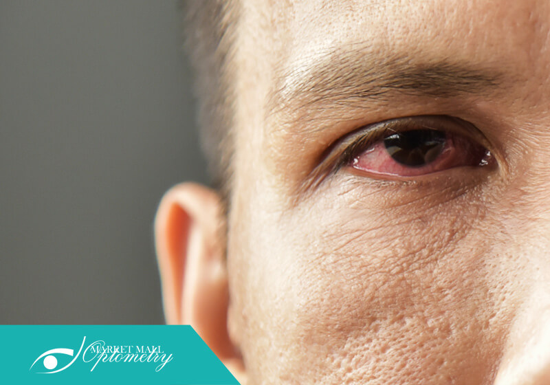 Close up of a man with an extremely red eye | Calgary Eye Clinic