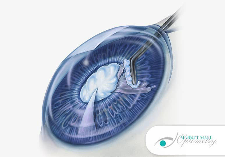 Market Mall Optom - Blog - What Are The Symptoms Of Cataracts