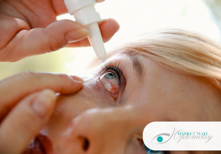 Dry Eyes in Winter: How to Soothe and Protect Your Vision